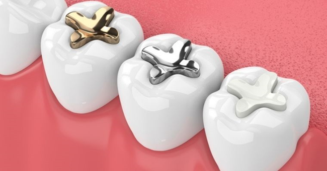 Key difference between Silver, Gold, Ceramic and other types of fillings