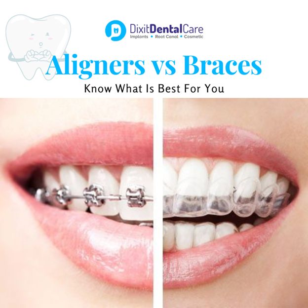 Braces vs Aligners: Things to Consider